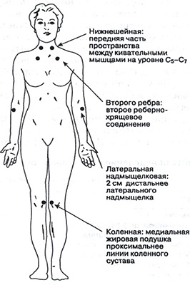 Триггерные точки при фибромиалгии