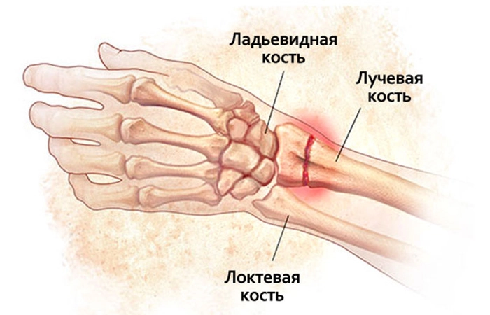 Перелом лучевой кости
