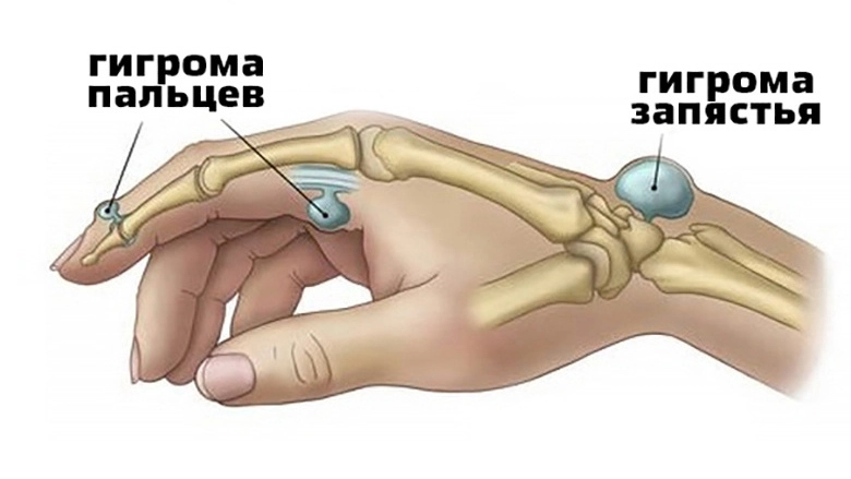 Гигрома