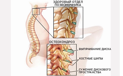 Последствия шейного остеохондроза