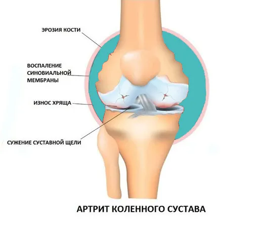 Артрит и артроз: в чем разница между ними?